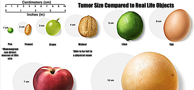 Stages Of Cancer Tumor Size